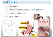 Gastrostomía